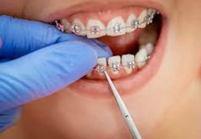 What Are the Reasons to have Braces?