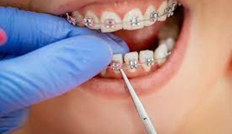 What Are the Reasons to have Braces?